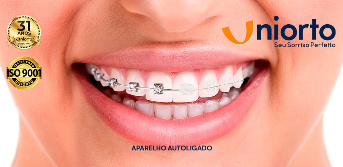 Aparelho Autoligado — foto do tratamento na Uniorto