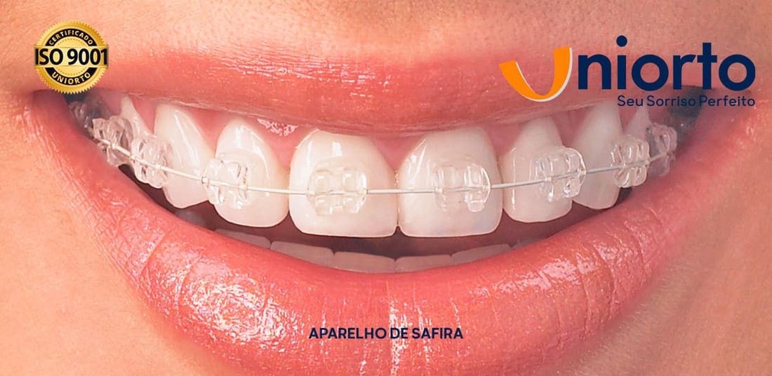 Aparelho de Safira — foto do tratamento na Uniorto